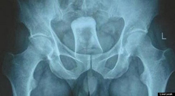 Shot Glass Inserted Into Anus Of Chinese Man Who Was Asked For 