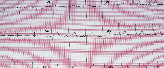 brady bradycardia