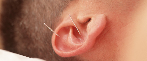 ear acupuncture for weight loss