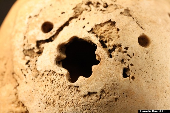 Signs Of Cranial Surgery Seen In Peruvian Skulls Dating Back 1,000