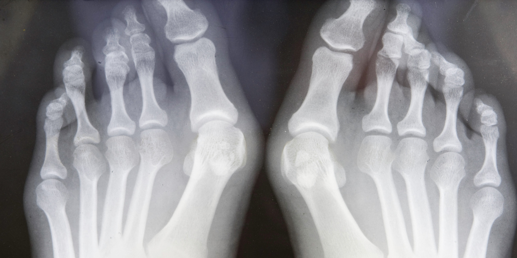 Foot Osteoarthritis Affects One In Six People Over 50 HuffPost UK