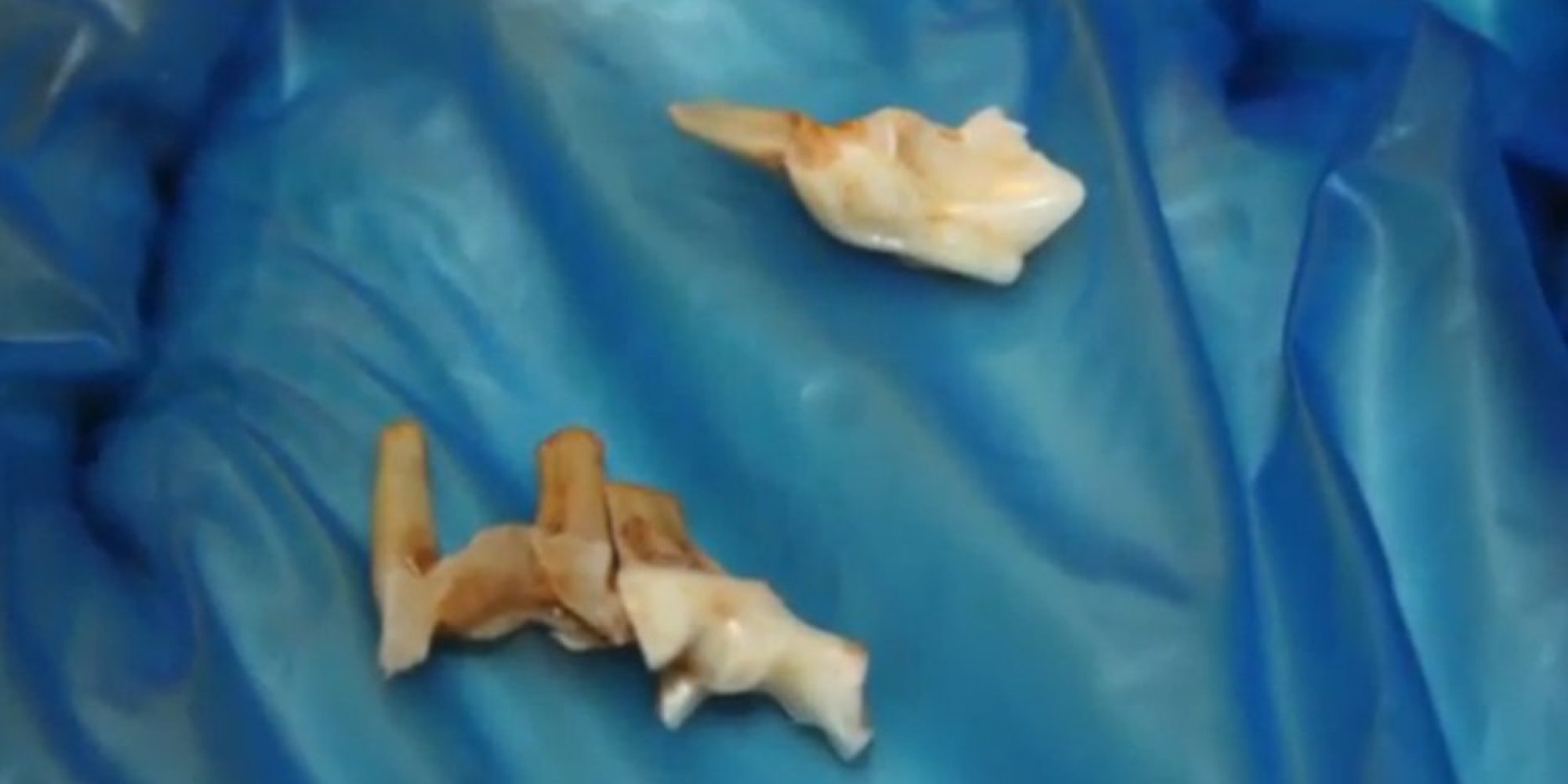 Graham Calder Finds Strange Tooth In Bag Of Peanuts HuffPost