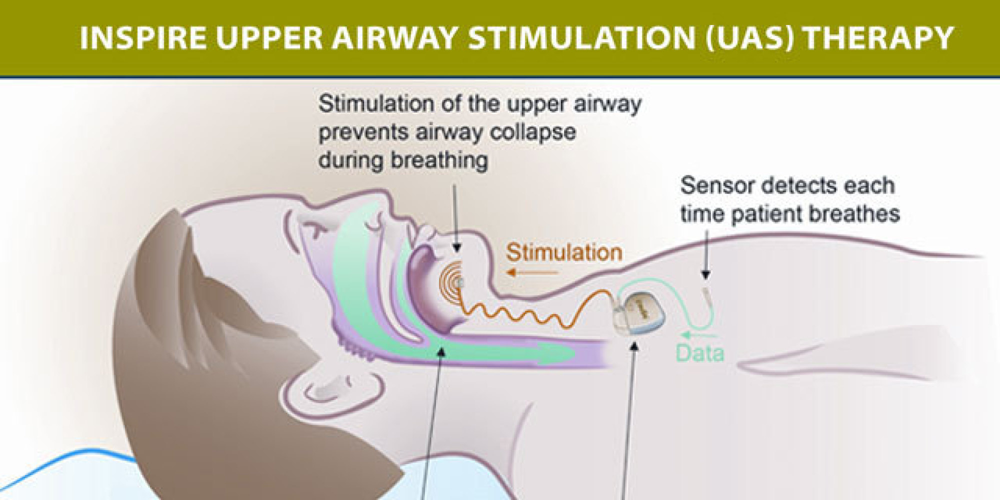 Mild Electronic Stimulation Therapy Effective For Sleep