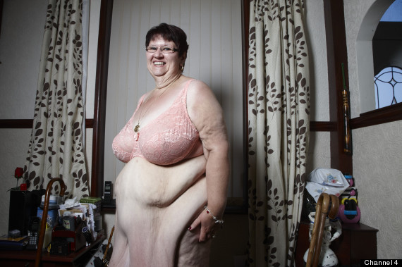 Excess Skin After Weight Loss Surgery On Nhs Jobs