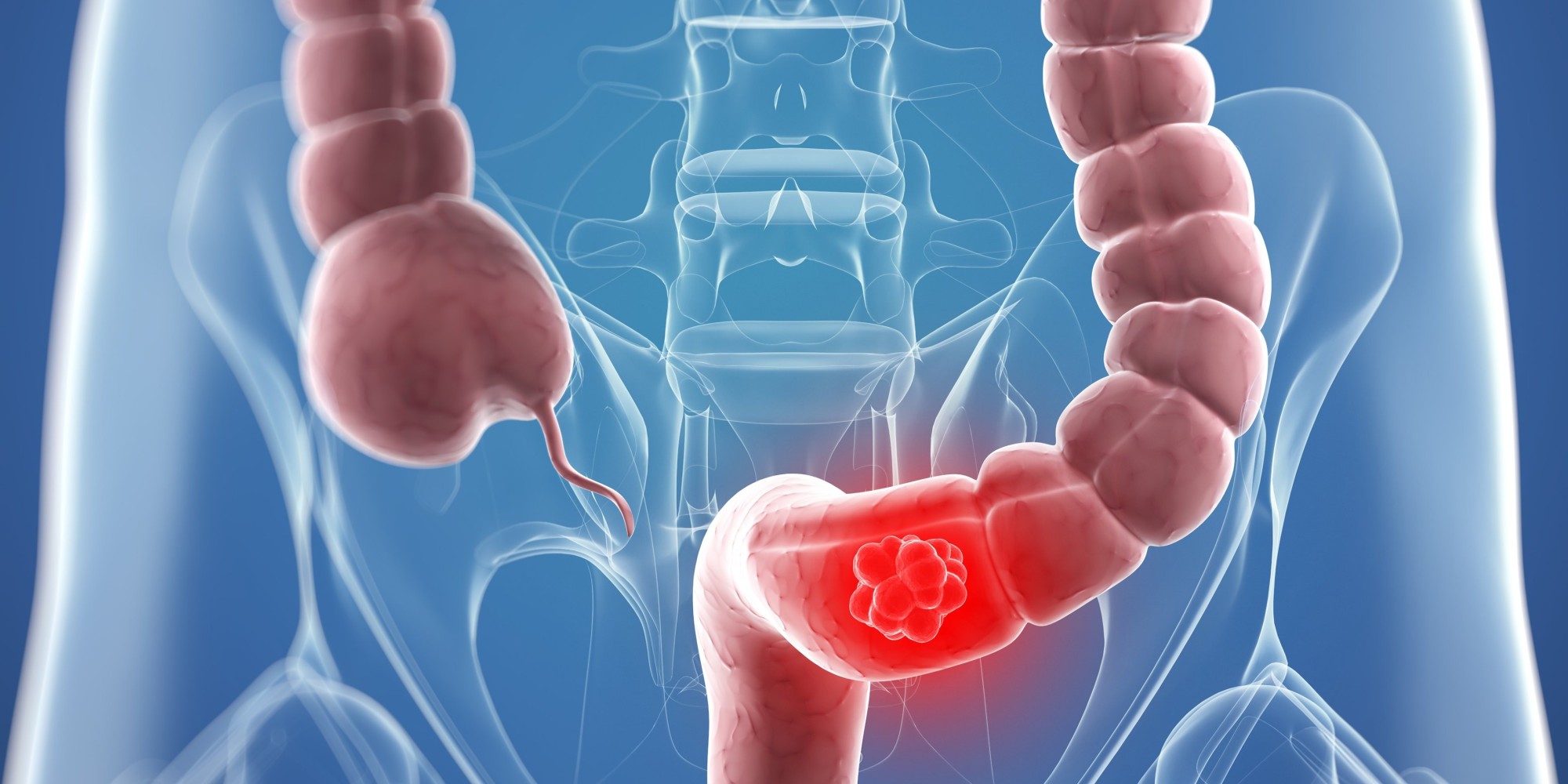 Can Cancer Affect Bowel Movements