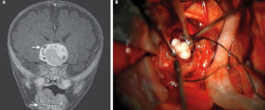 Brain Tumor Teeth