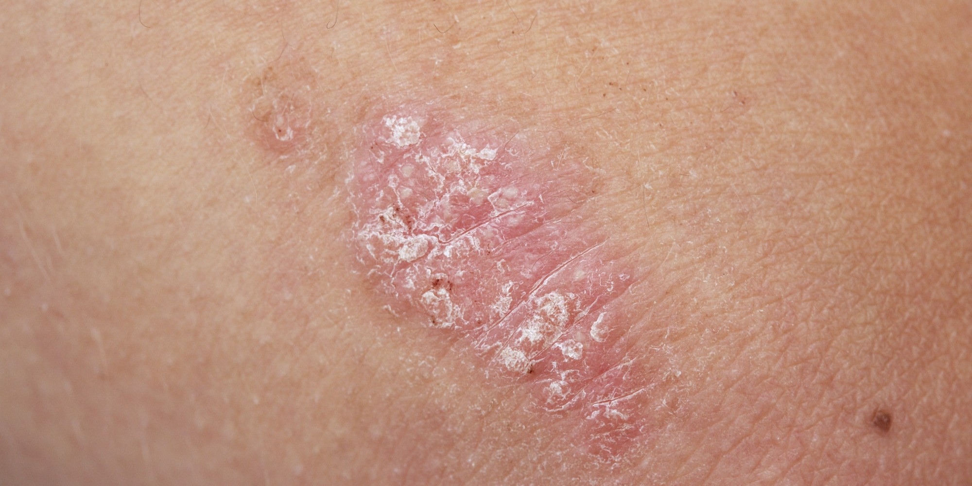 animal-study-paves-way-for-future-psoriasis-treatment-huffpost