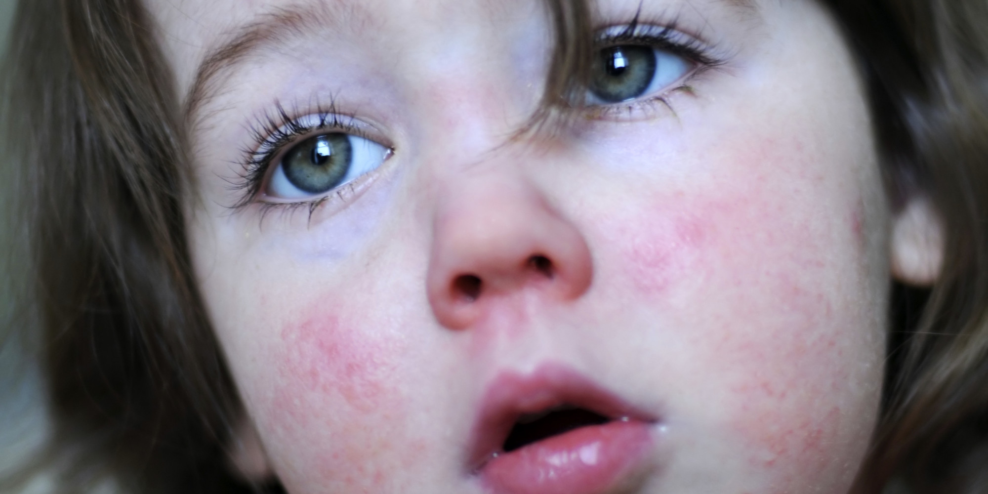 What does a red rash around your neck mean? - Wound Care ...