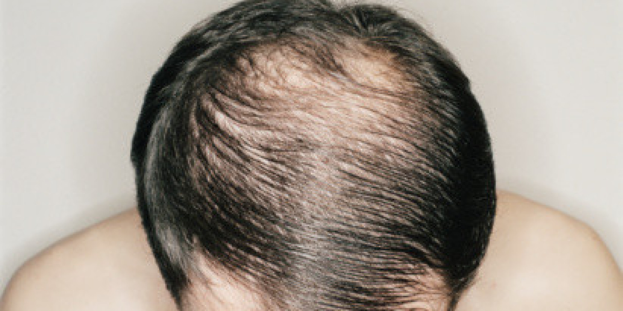 5 Habits That Are Making You Lose Hair