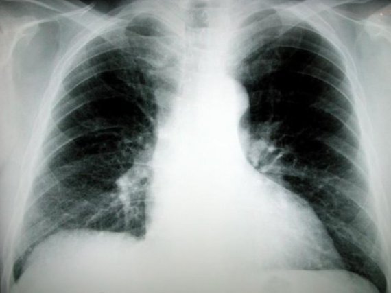 Lung Cancer Drug