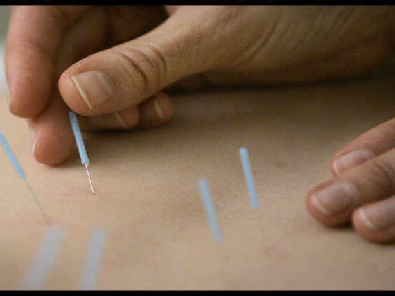 Acupuncture