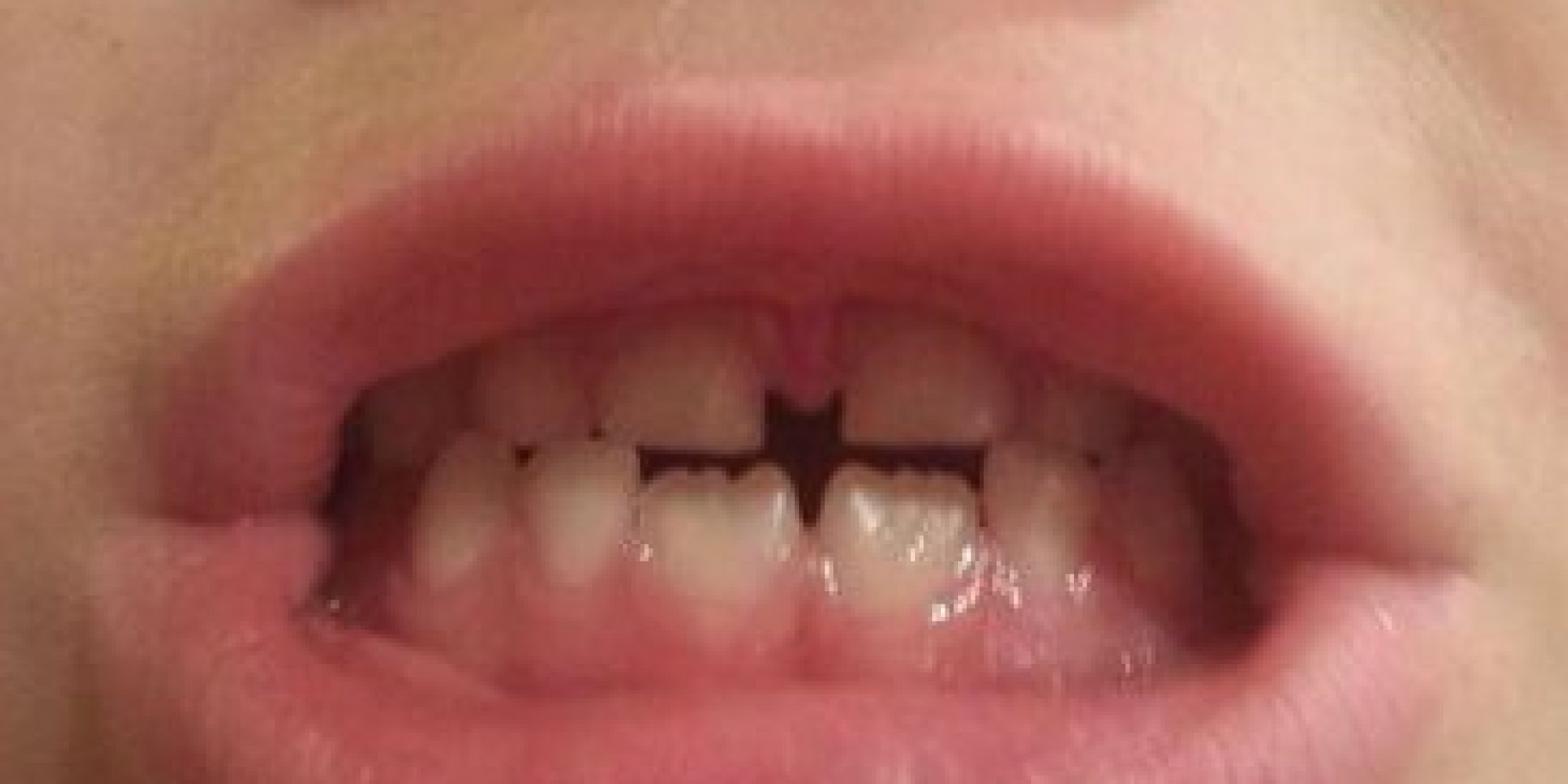 My nephew has the batman symbol in the gaps of his teeth r