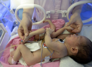 Baby Deformed