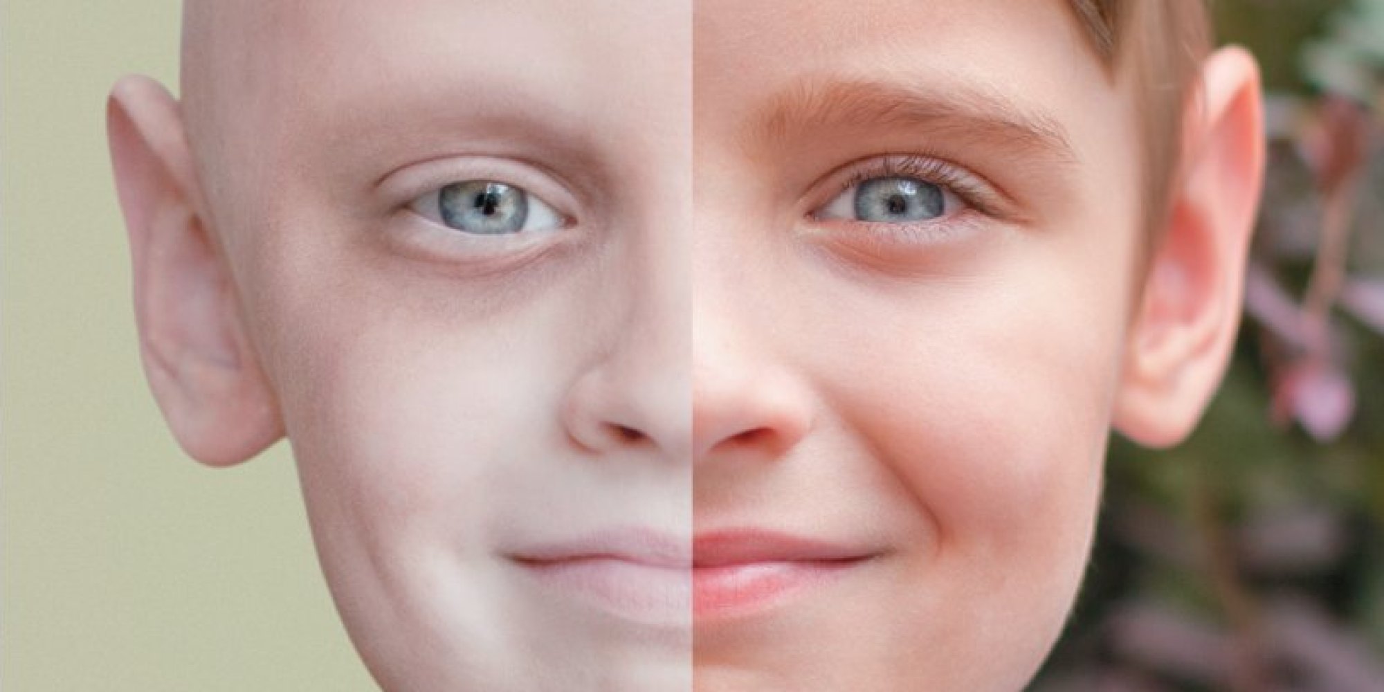 striking-before-and-after-photo-illustrates-childhood-cancer-survivor-s