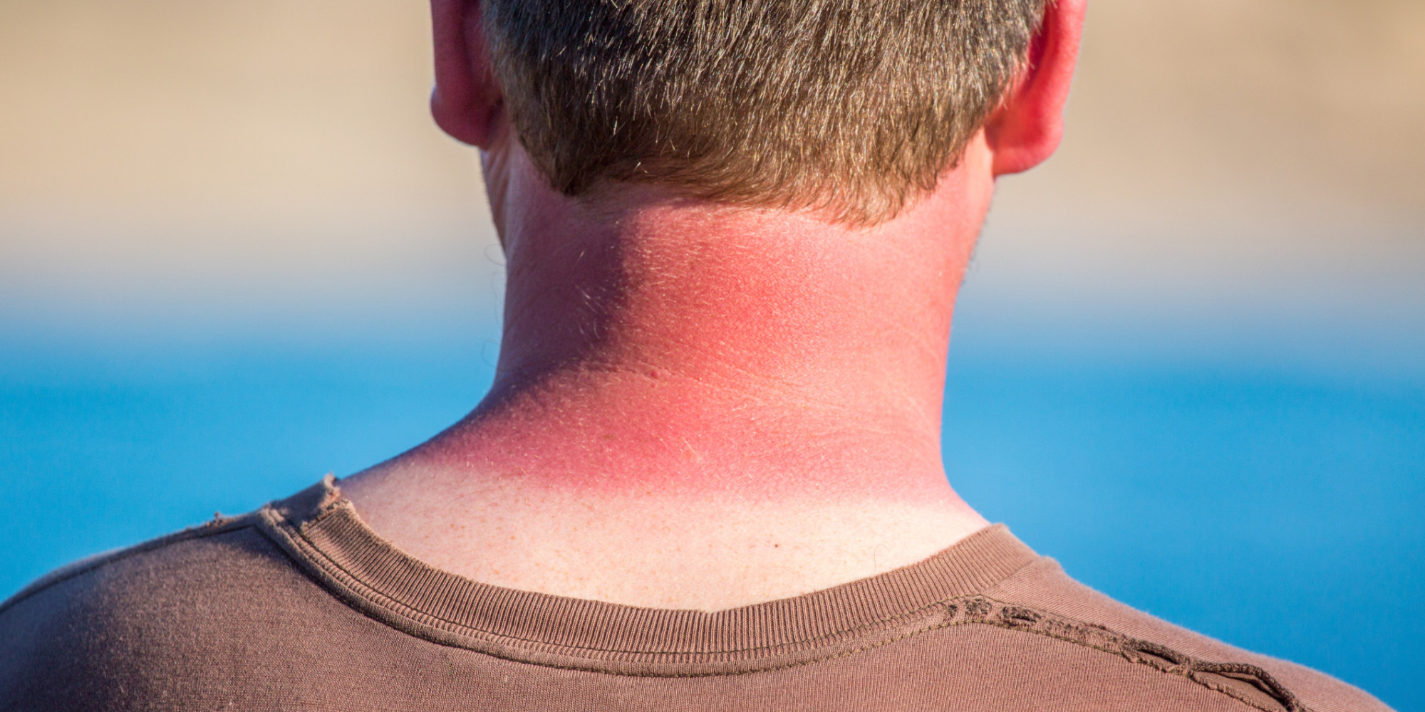 Getting Really Bad Sunburns As A Teen Could Raise Skin Cancer Risk Huffpost