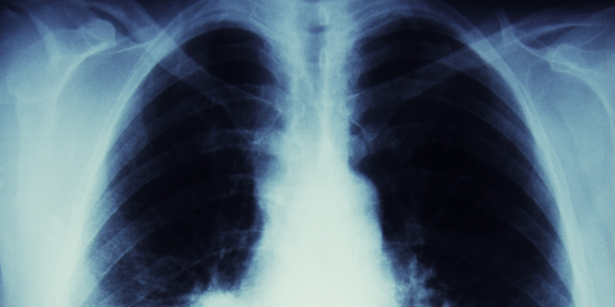 This Breath Test Could Help Sniff Out Lung Cancer HuffPost