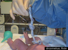 Umbilical Cords Save Lives, But Nearly All Of Them Get Thrown Away