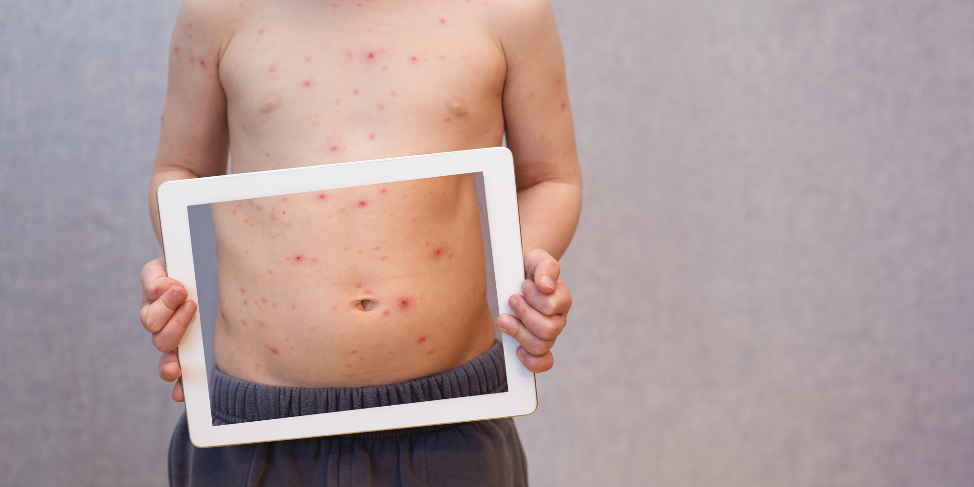 iPad Rash? Nickel In Electronic Devices May Cause Irritation, According