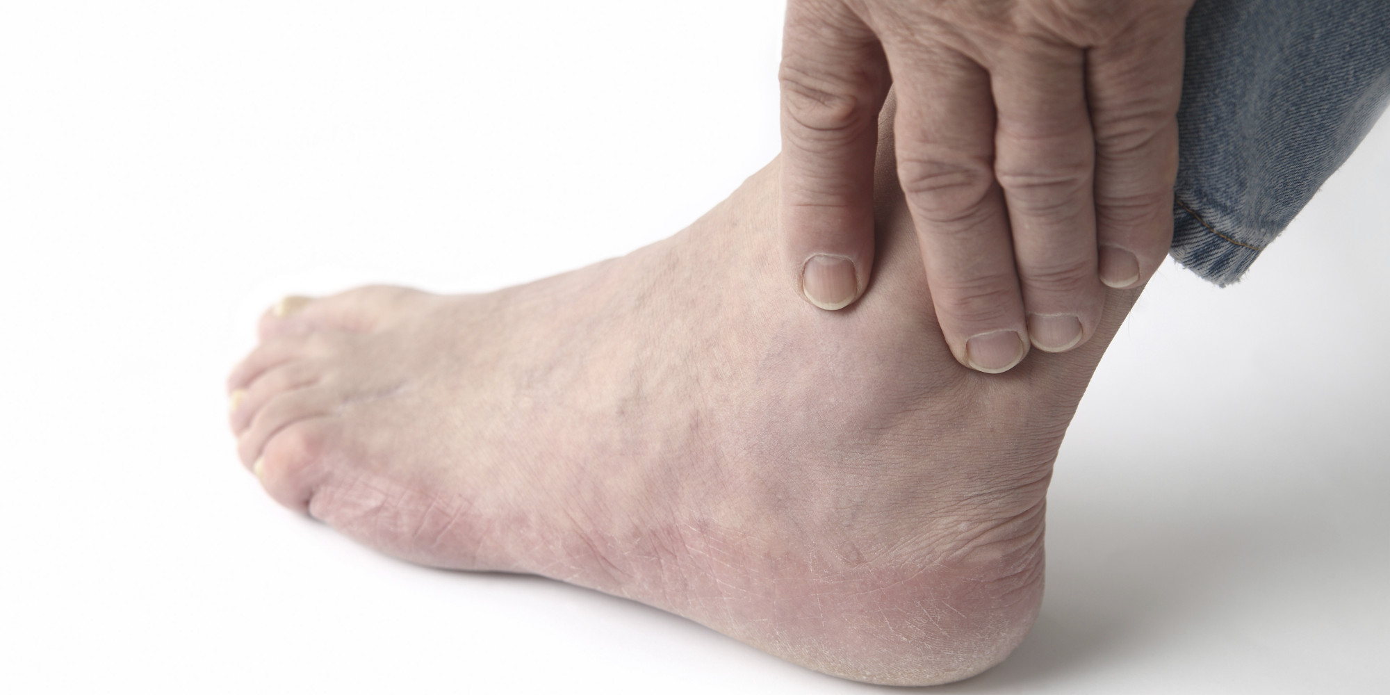 GOUT DISEASE gout disease: