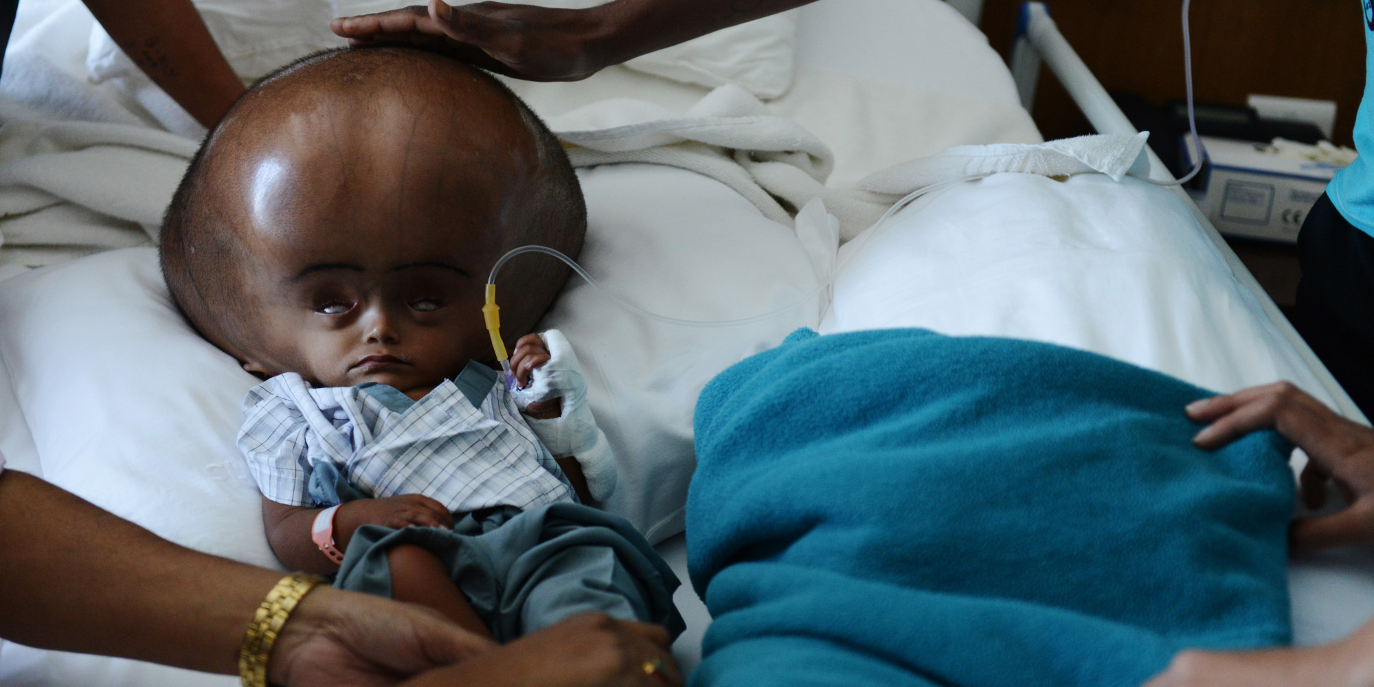 Roona Begum, Girl With Hydrocephalus, Beats Doctor's Odds ...
