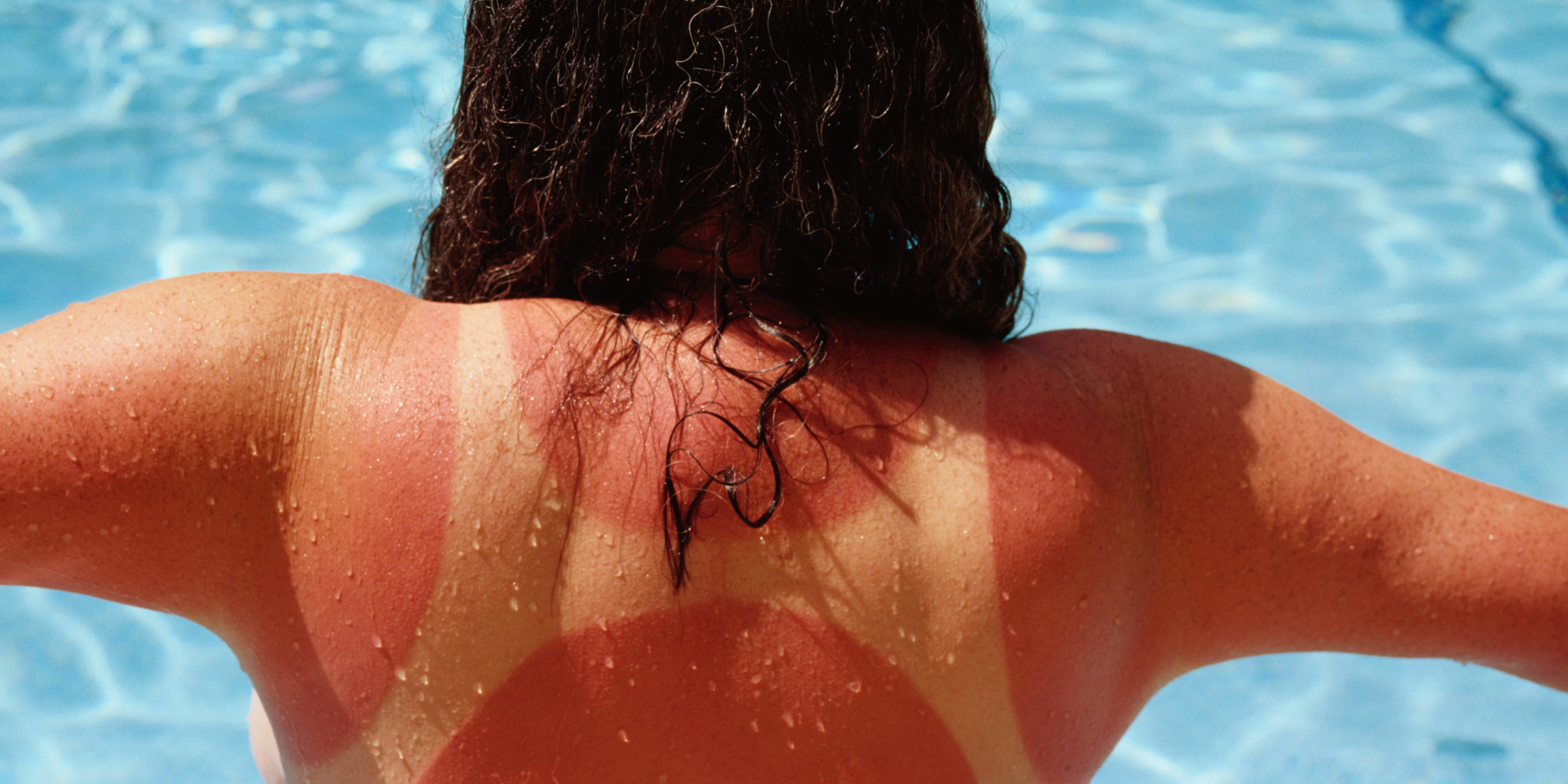 Image result for sunburn