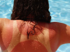 10 Tips For Treating A Bad Sunburn