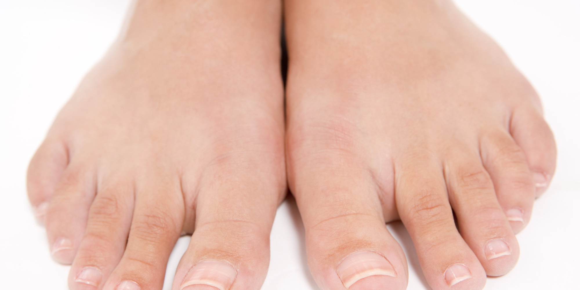 How To Get Rid Of Gout In Toe