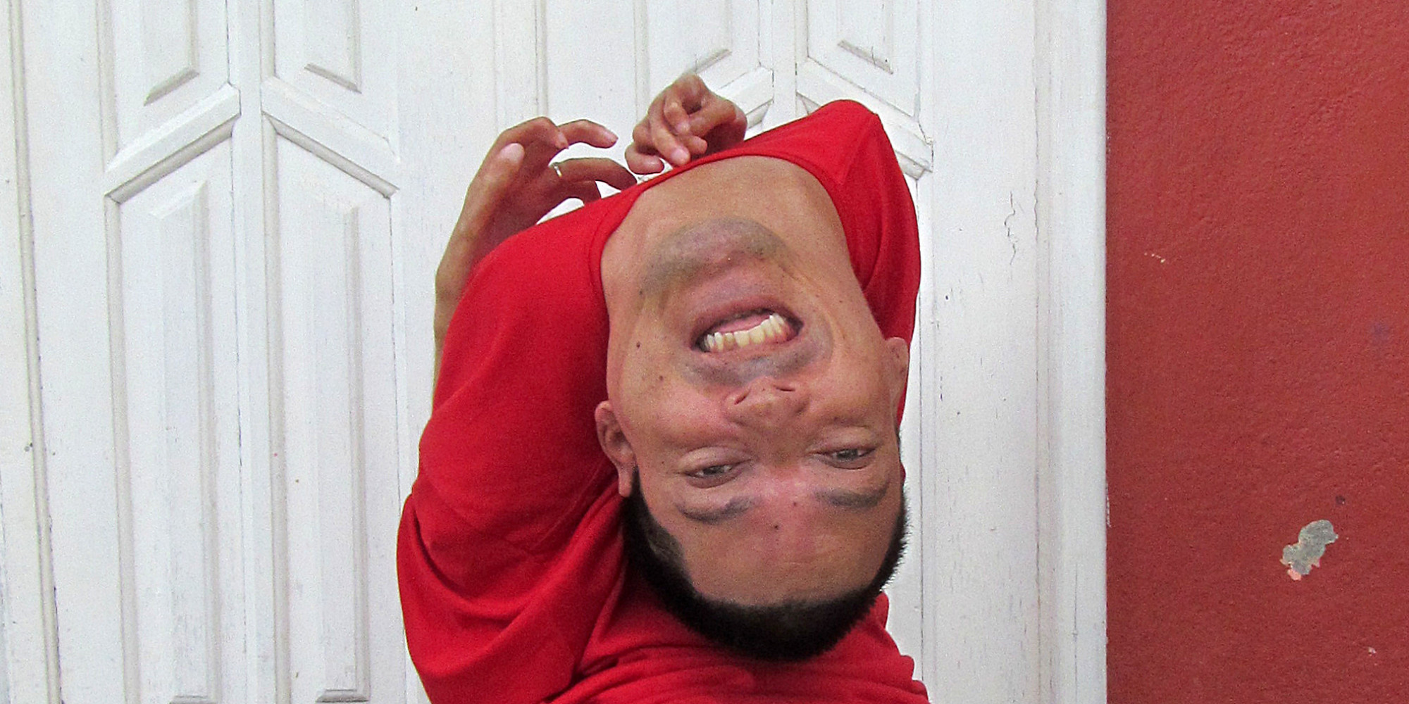 Man Born With The Upside Down Head Claudio Vieira De Oliveira Becomes 