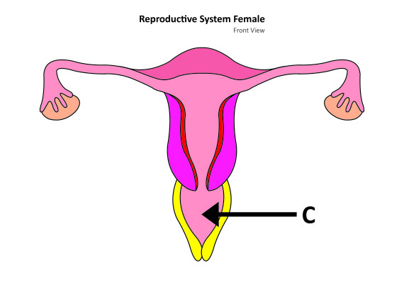 vaginal cancer