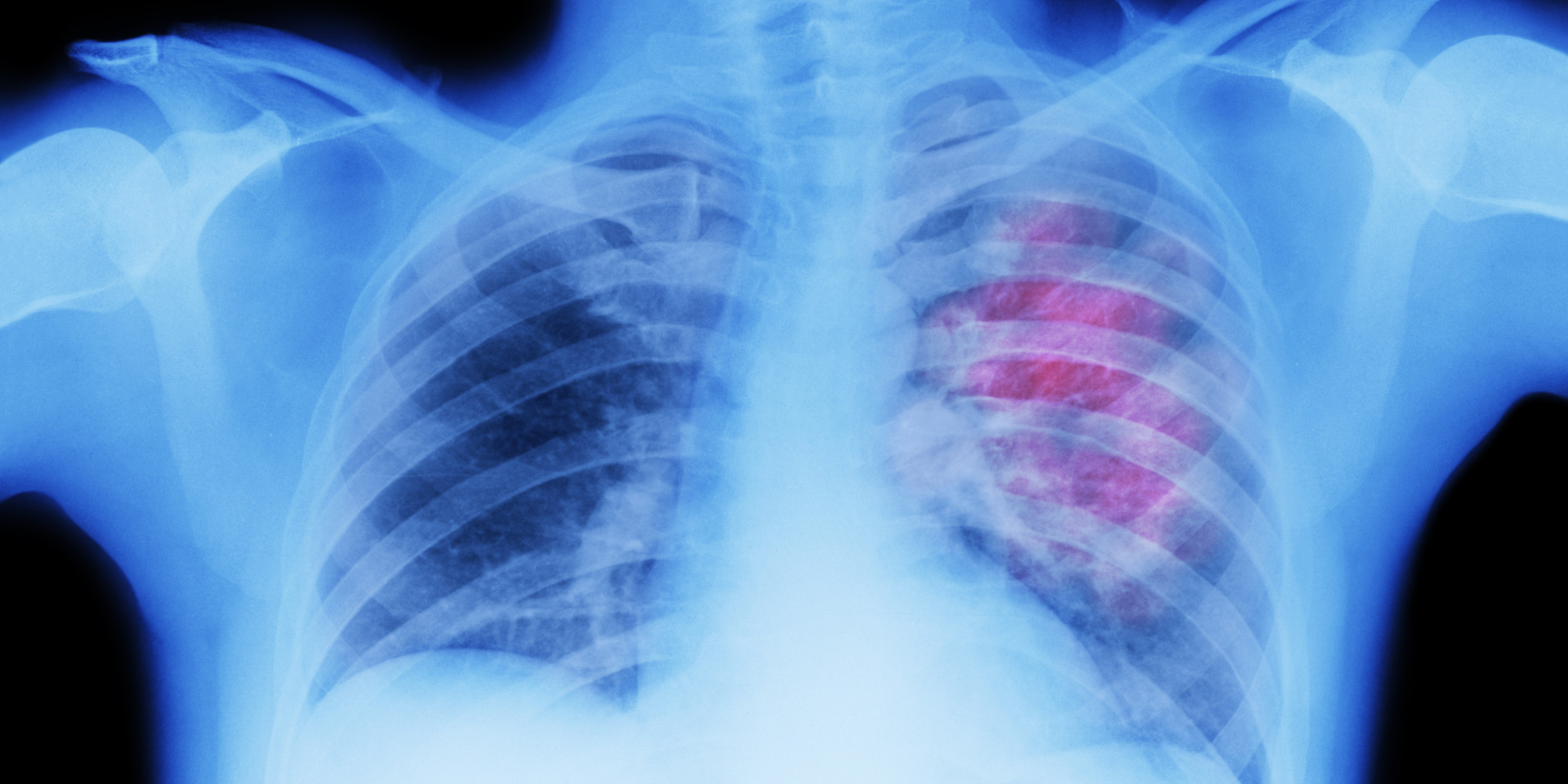 A New Breath Test Could Detect Signs Of Lung Cancer Well Before It