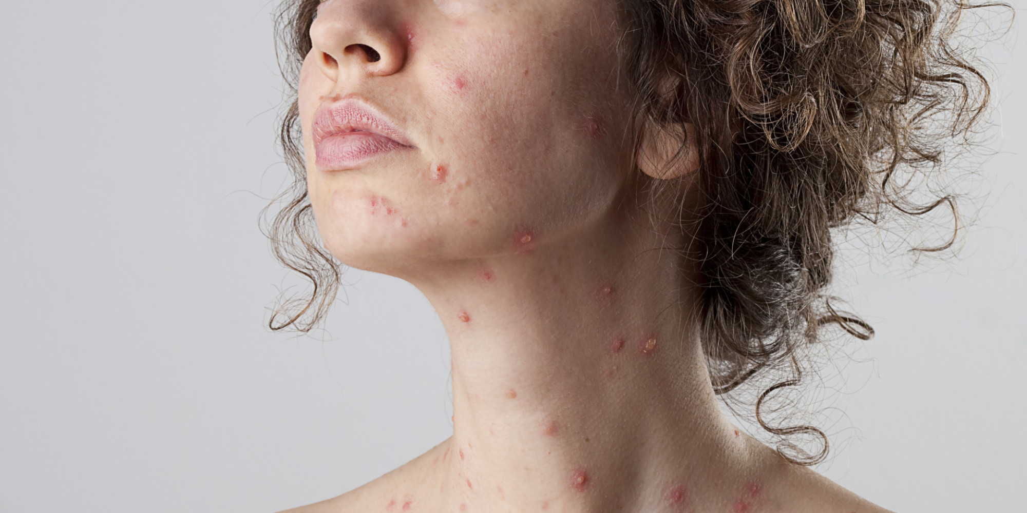 chickenpox signs