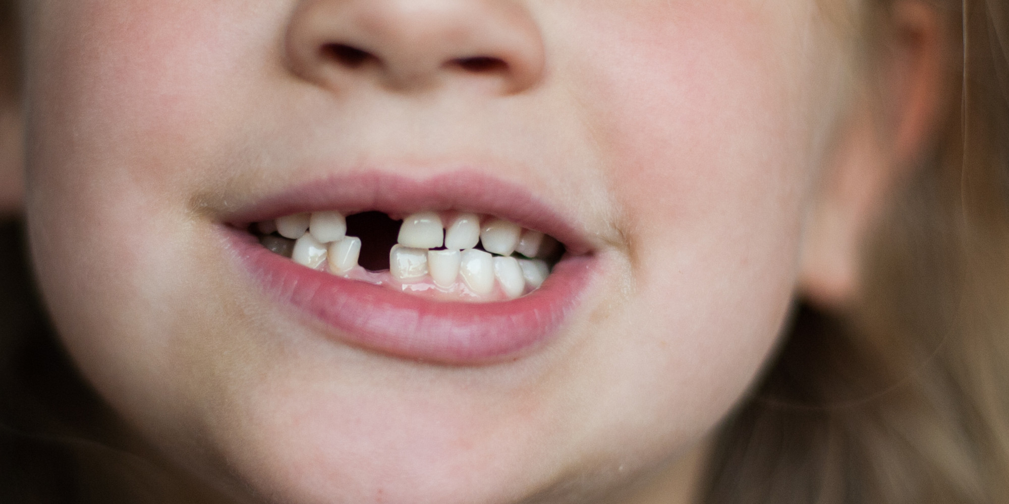 is-your-child-a-mouth-breather-there-s-new-help-at-the-dentist-huffpost