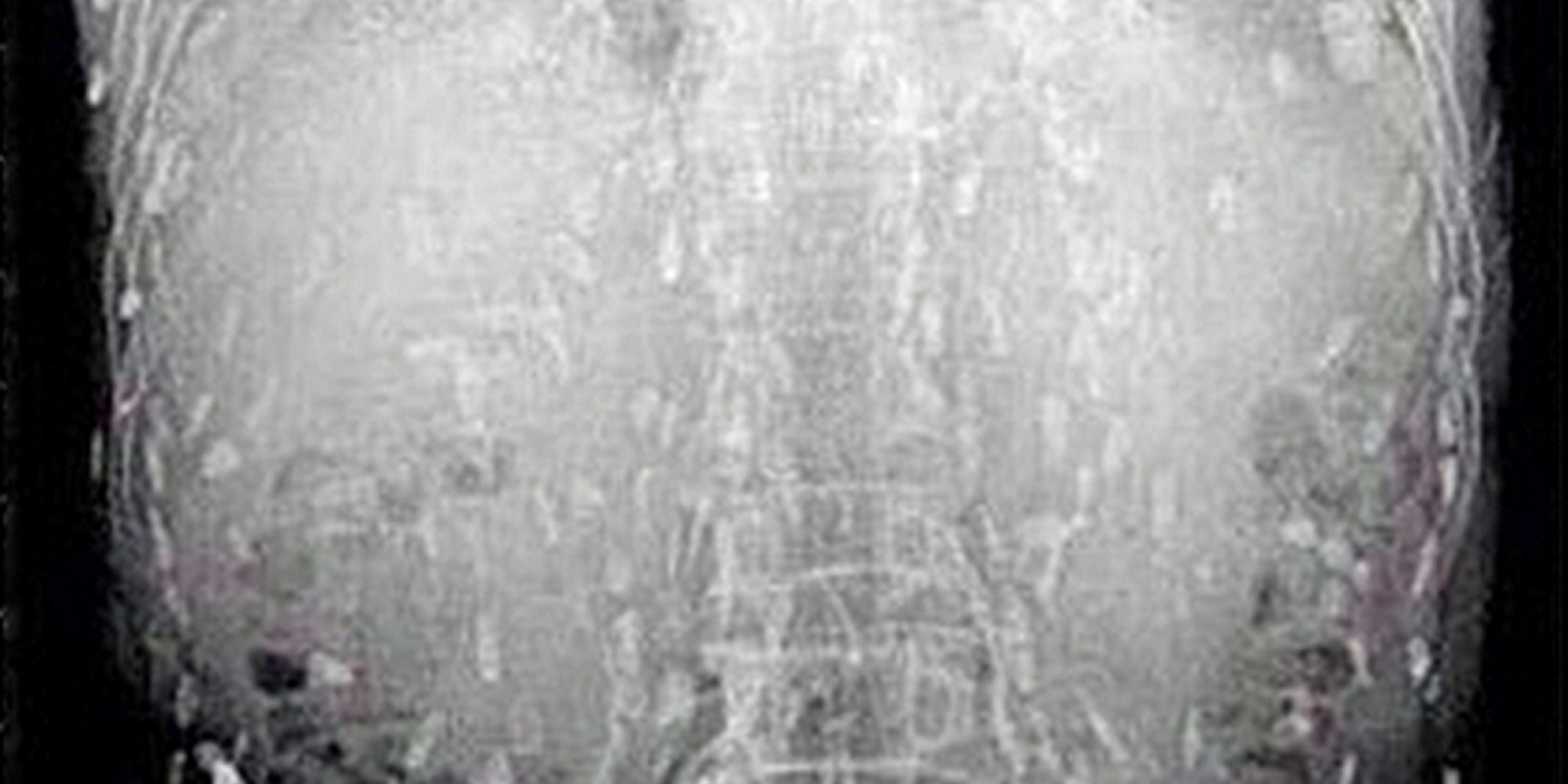 Chinese Man 'Gets Infected By Hundreds Of Tapeworms After Eating