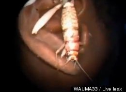 Man Discovers Three-Inch Cricket Living In His Ear