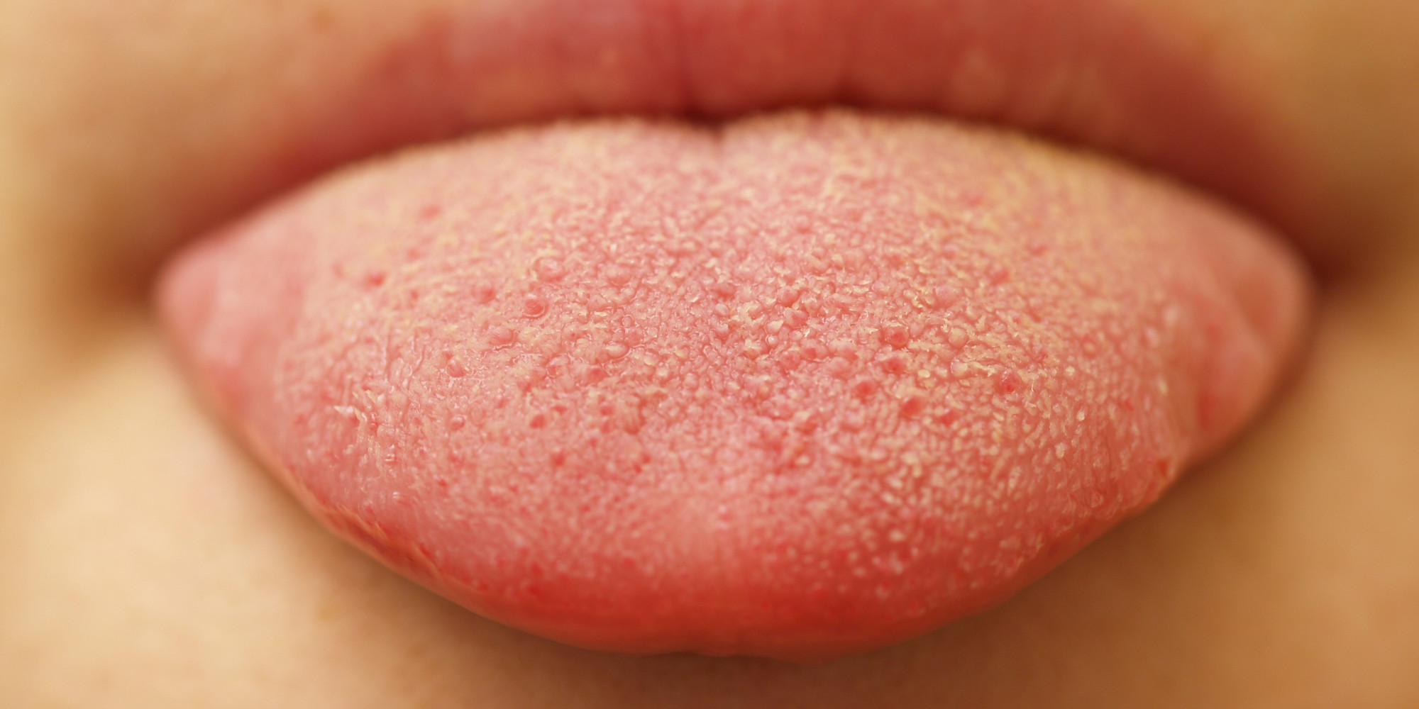 white-spots-on-tongue-tip-side-under-back-dots-patches-single