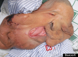 Life-Changing Surgery For 'Elephant Man' With 25kg Facial Tumour