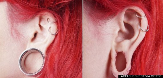 Cosmetic Surgery To Repair Stretched Earlobes Aka Flesh Tunnels Is On 