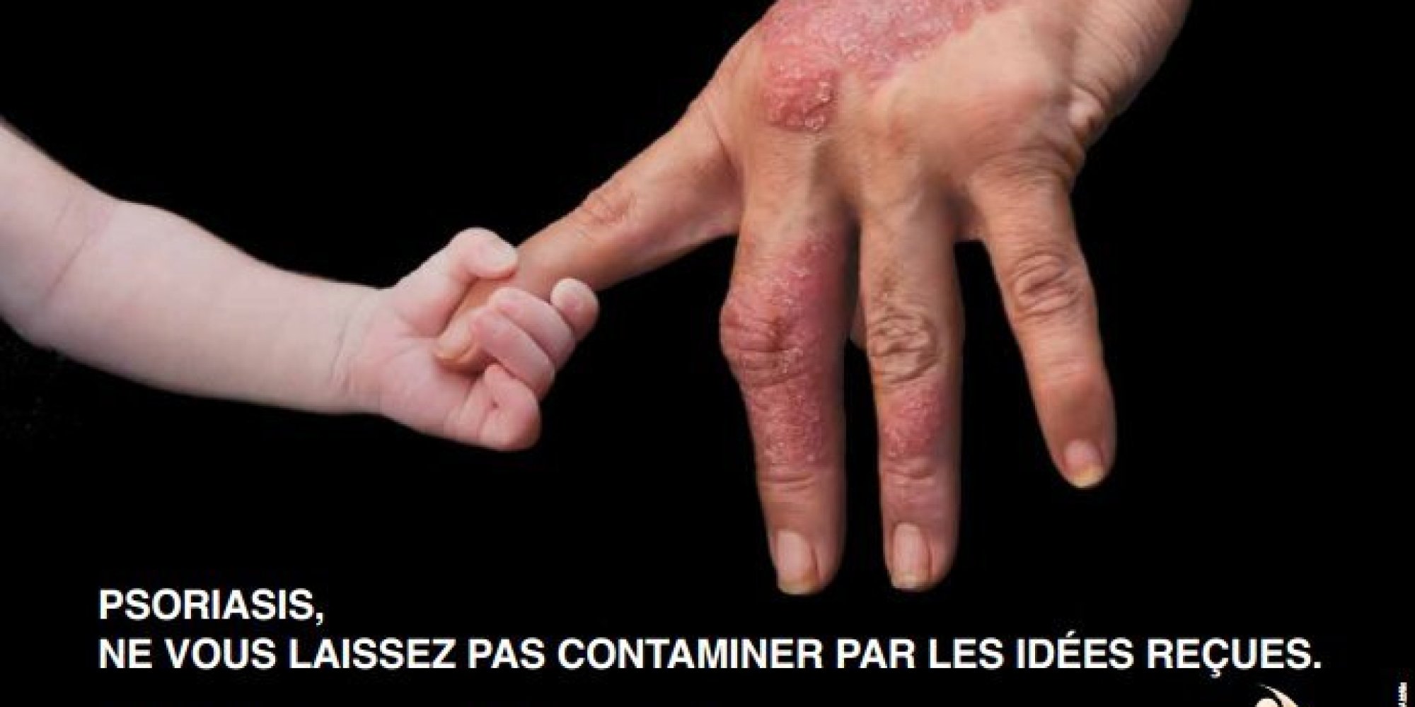Les onguents non hormonaux des eczémas à bras