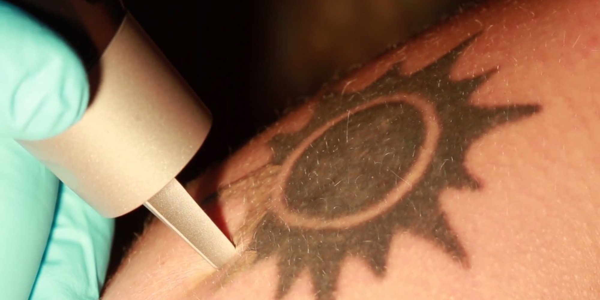 ... Reality Of Having A Tattoo Removed With Lasers | The Huffington Post