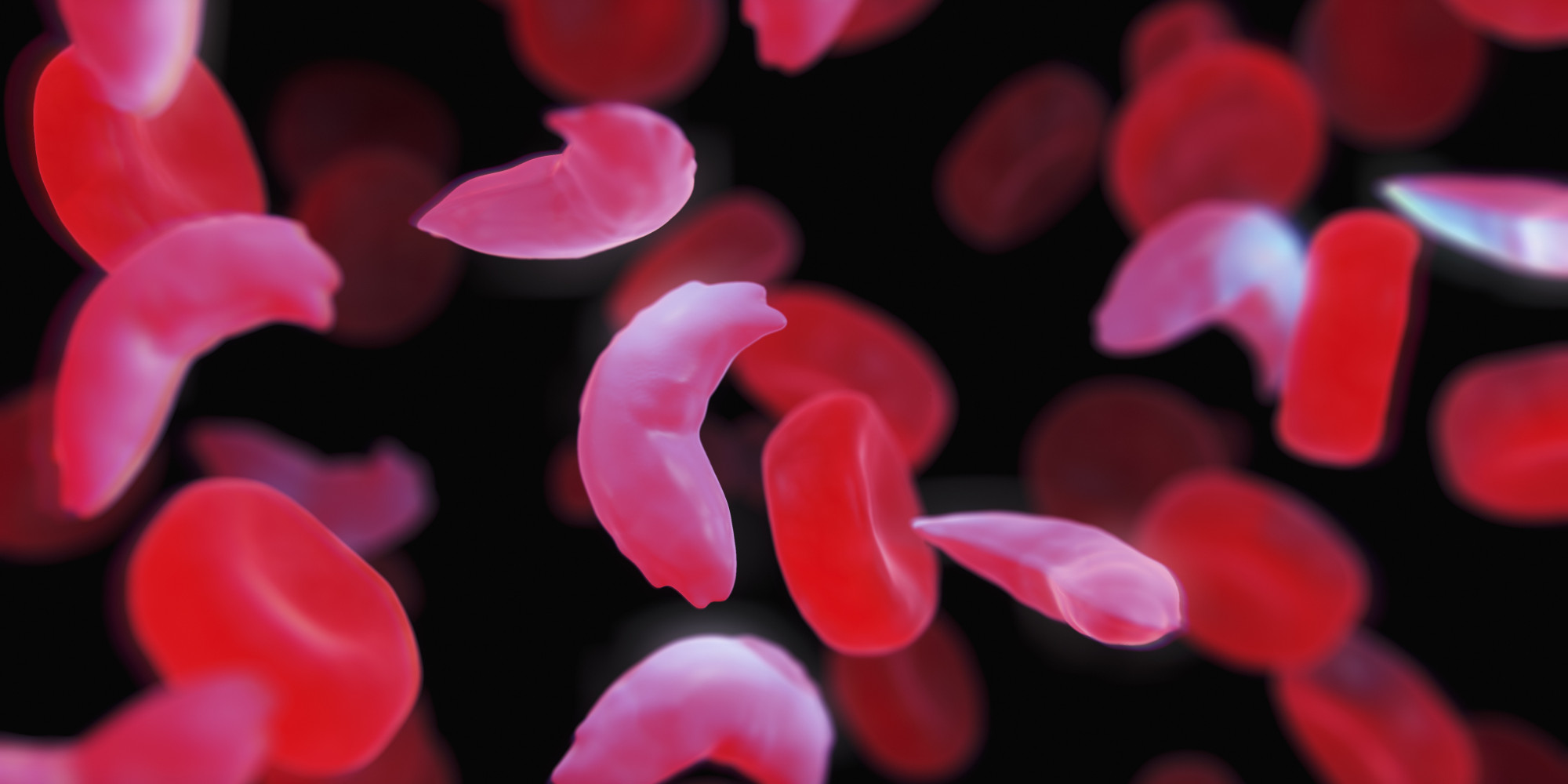 Black Americans With Sickle Cell Trait At Increased Risk ...
