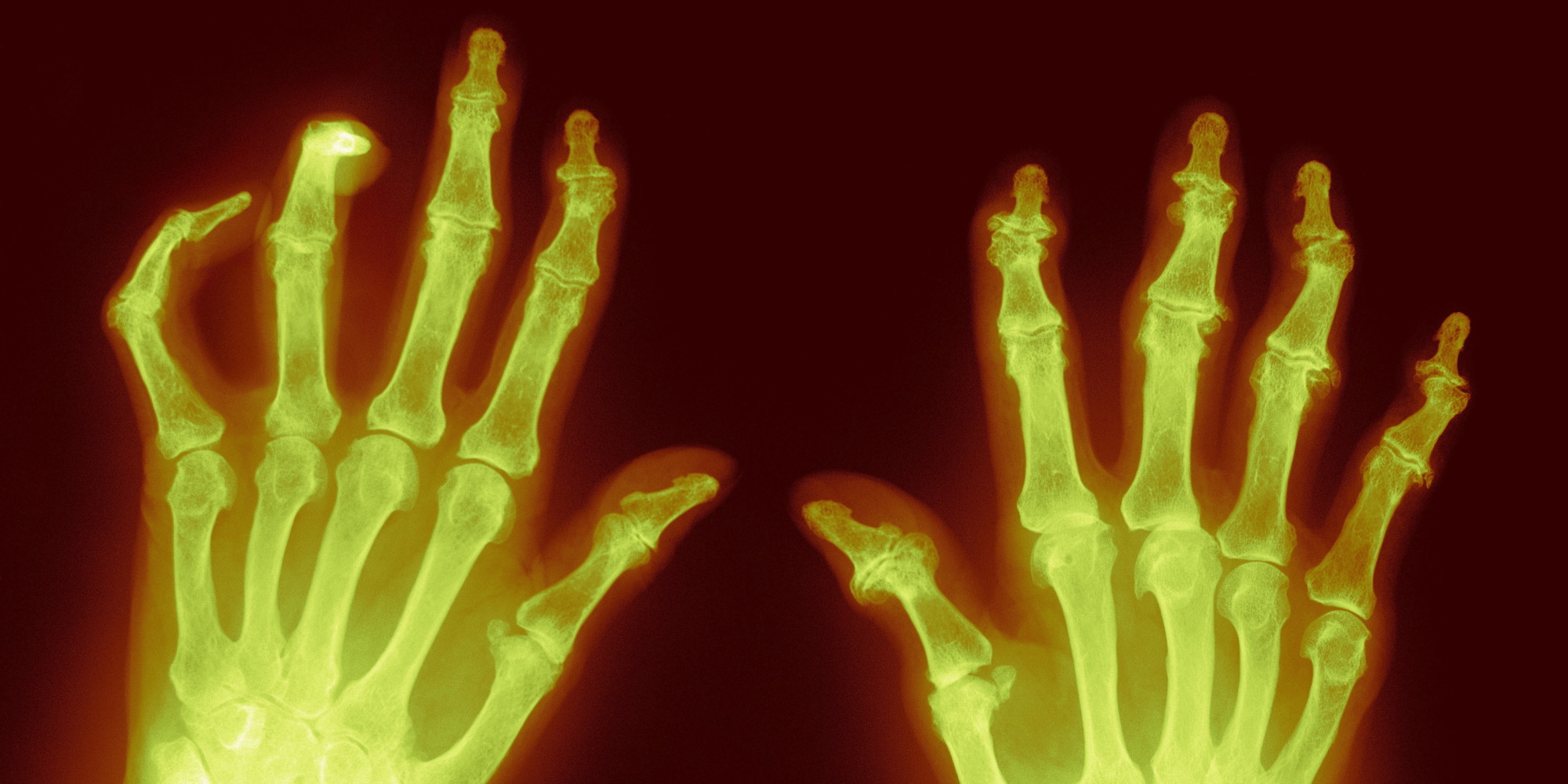 osteoarthritis-2-common-treatment-misconceptions-huffpost