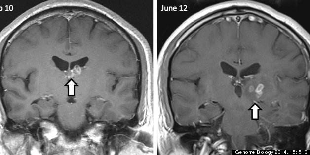 Man's Headaches Caused By A Tapeworm Living In His Brain