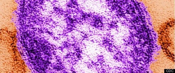 Measles