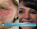 Woman Tattoos Her Own Face To Cover Scars, Starts Business To Help Other Burn Victims