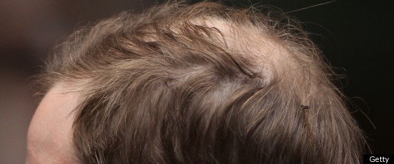 Hair Transplant