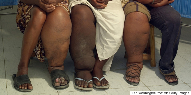 Historic Health Push Aims To Wipe Out Elephantiasis, Disease That Causes Intense Social Stigma And Pain