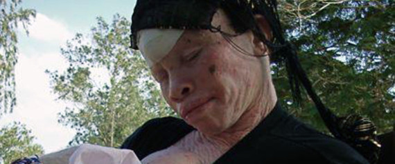 Tanzania Albinos