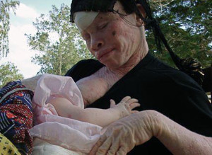 Tanzania albinos - AIDS - murder