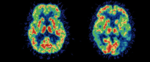 Alzheimers Risk