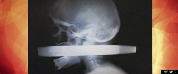 Face Impalement